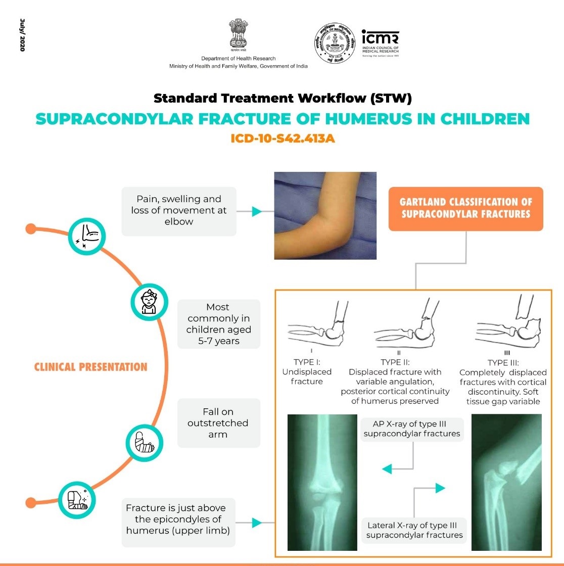 Supracondylar Fracture of Humerus in Children